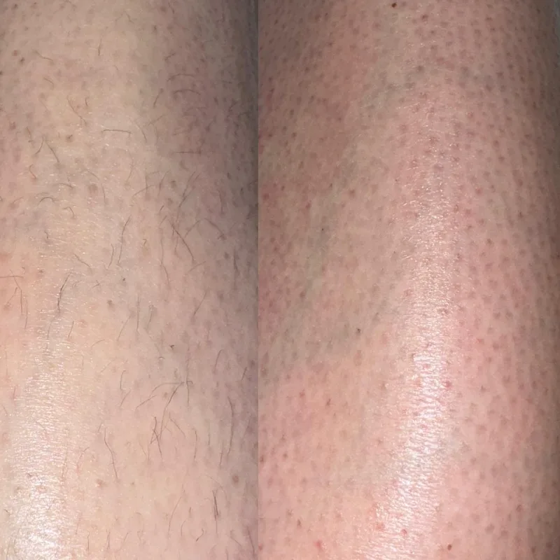 Leg waxing before and after